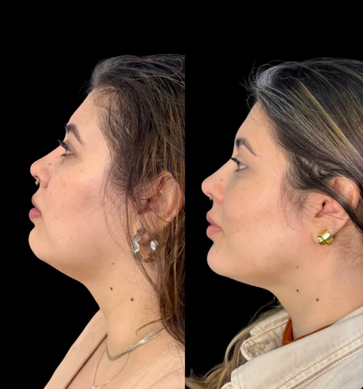 Paciente em planejamento de harmonização facial com a Dra. Luiza
