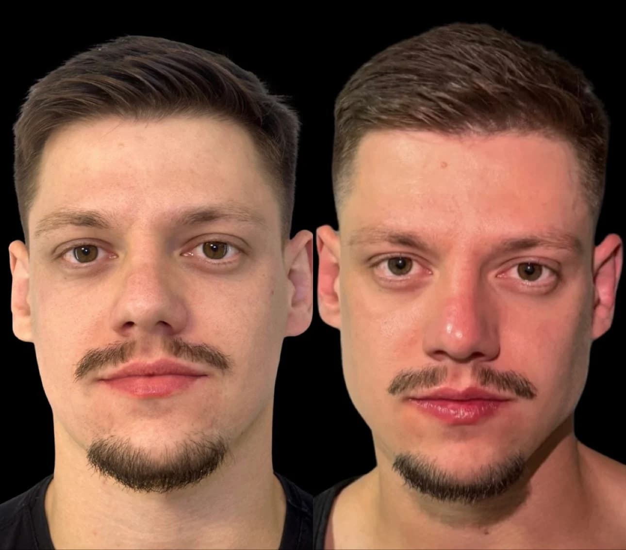 Atendimento relacionado à harmonização facial masculina