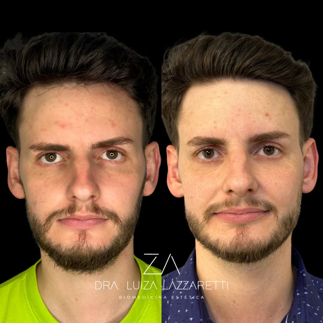 Análise facial para planejamento de mandíbula