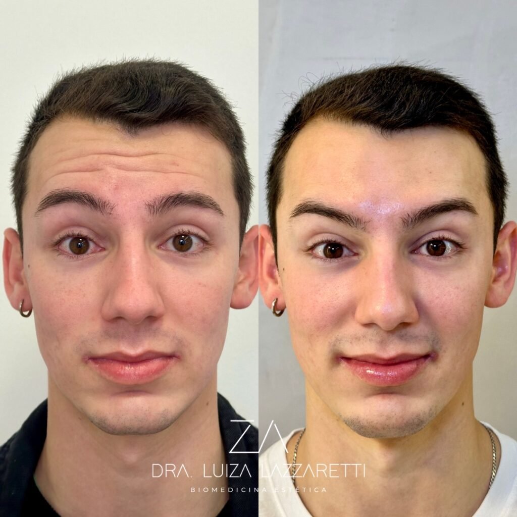 toxinabotulinica-botox-draluizalazzaretti