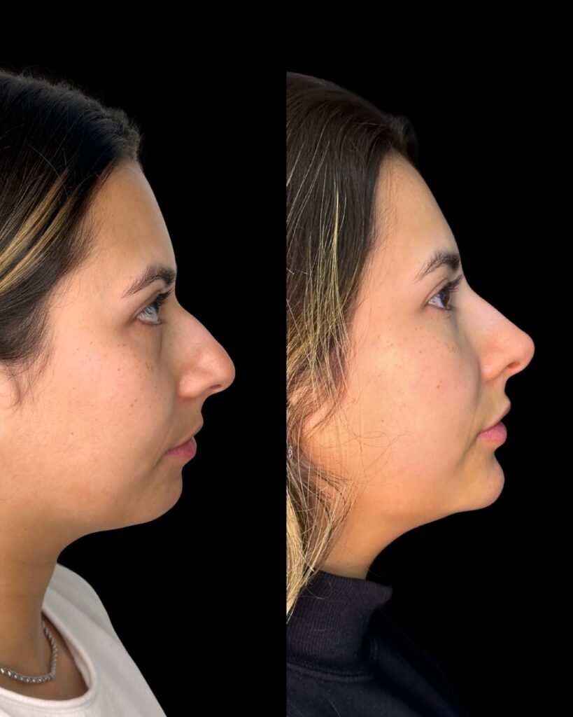 Perfiloplastia-DraLuizaLazzaretti